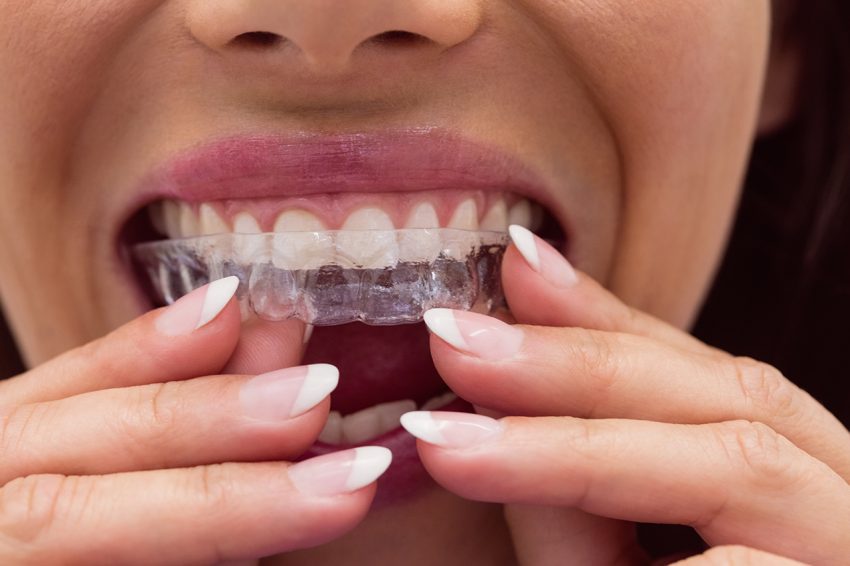 Invisalign: Revolutionising Orthodontic Comfort